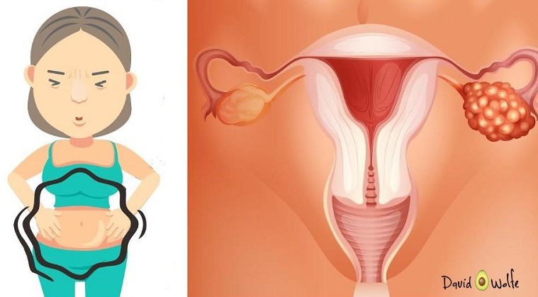 ovarian cancer or constipation)