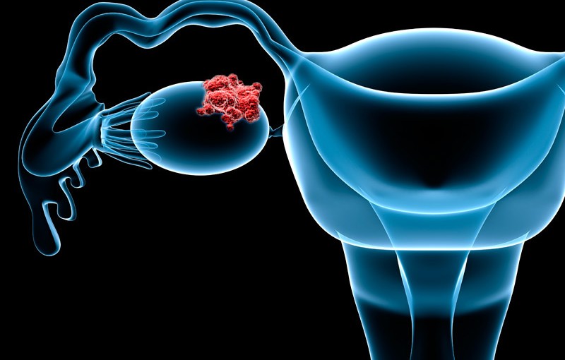 PARP Inhibitor Shows Benefit in Ovarian Cancer