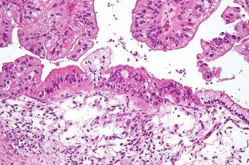 New Blood Test Developed To Diagnose Ovarian Cancer