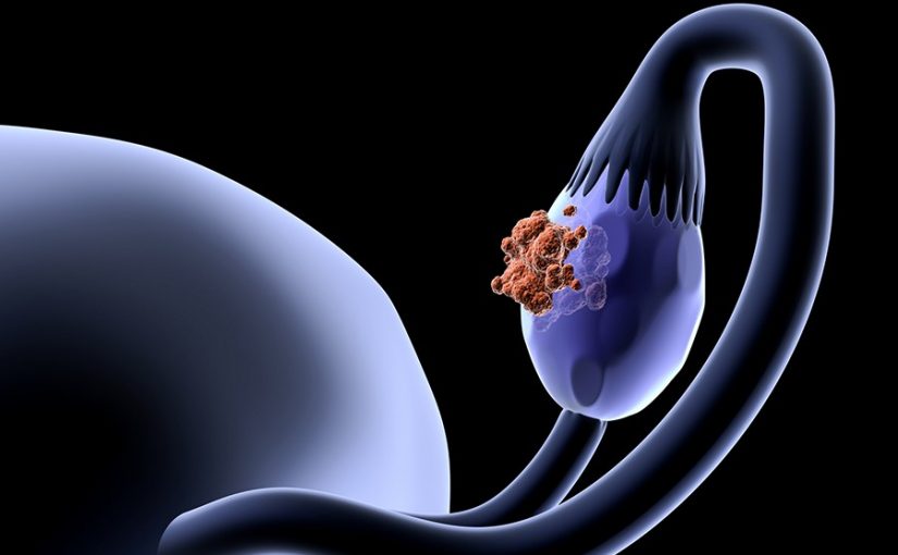 Combinations May Be The Future Of Immunotherapy In Ovarian Cancer