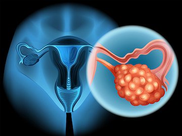 ‘No’ to Ovarian Cancer Screening: Harms Outweigh Benefits