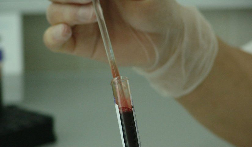 The CA125 Blood Test: Your Questions Answered
