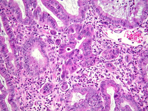Rare Ovarian Cancer Confirmed as Not Seeded from Elsewhere