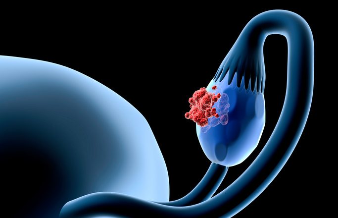 Frontline Niraparib Plus Bevacizumab for Advanced Ovarian Cancer Yields Promising Activity