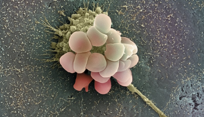 Neoadjuvant Chemotherapy Increases Immunogenicity of High-Grade Serous Ovarian Cancer