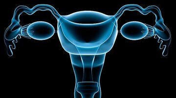 Two-Stage Surgery to Reduce Ovarian Cancer Risk Piques Interest