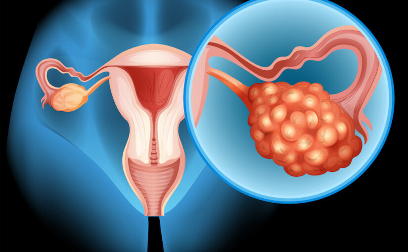 Addition of Bevacizumab to Pembrolizumab Improves Responses in Epithelial Ovarian Cancer