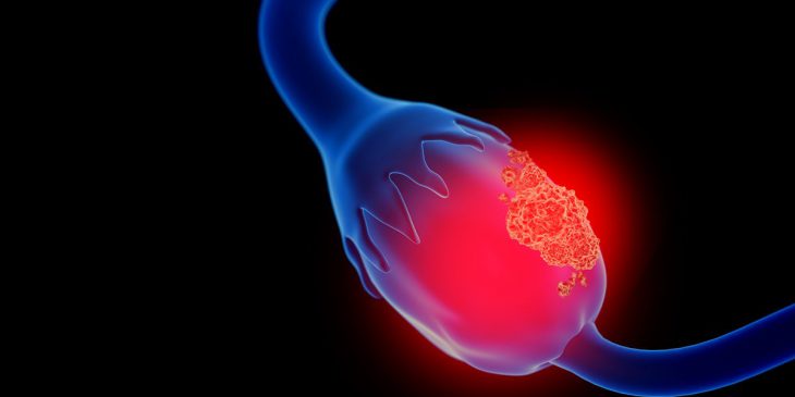 Study Points to New Approach to Improve Ovarian Cancer Treatment