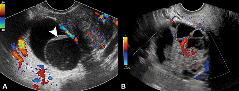 Representative transvaginal US images of nonclassic lesions; color Doppler blood flow with color bar signifies direction of flow. (A) Transverse color Doppler image of right adnexa depicts a multilocular cystic lesion with smooth septation (arrowhead) and no Doppler flow, compatible with a nonclassic lesion without blood flow. (B) Transverse color Doppler image of right adnexa depicts a multilocular cystic lesion with solid component and internal Doppler flow, compatible with a nonclassic lesion with blood flow.<br />
