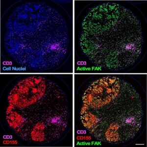 FAK (in green) makes tumors more malignant by binding to immune-regulating protein, CD155 (in red) and preventing CD3 expressing T cells (in magenta) from infiltrating the tumor. [UC San Diego Health Sciences]
