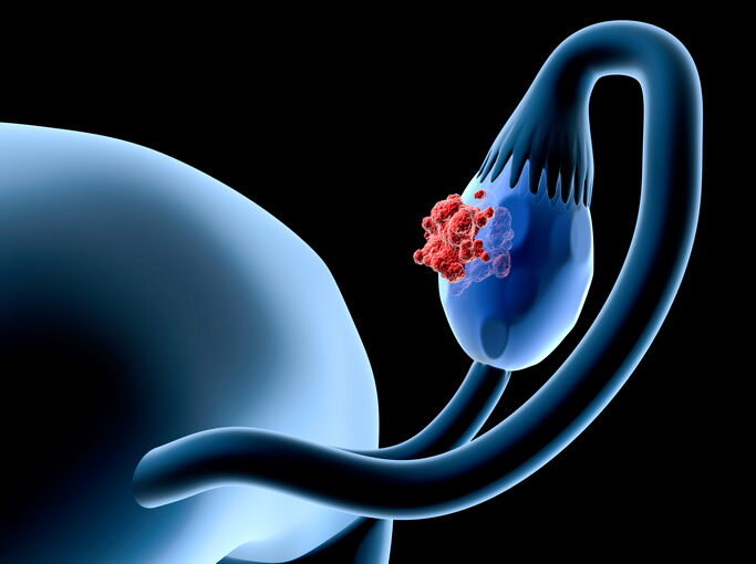 Tumor Testing May Be Increasingly Useful in Ovarian Cancer